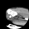 SPORK, NICO - 22.03.1976 - 02.08.2022 - CT obere Extremität - 17:51:17
